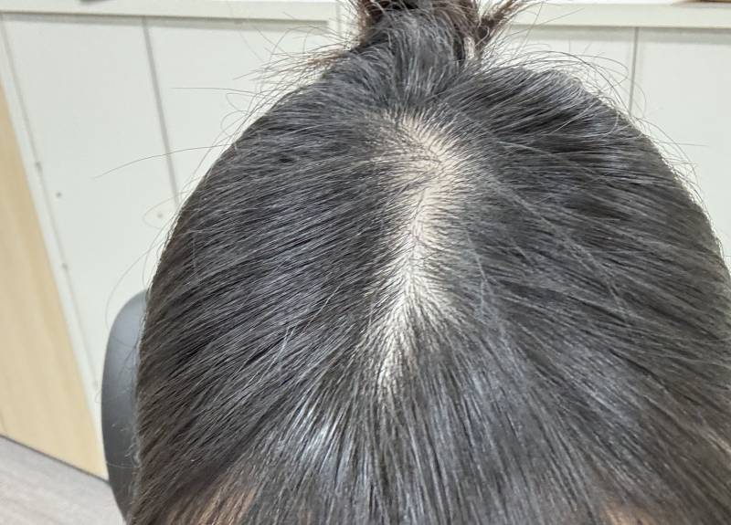 [잡담] 나 탈모인가...? | 인스티즈