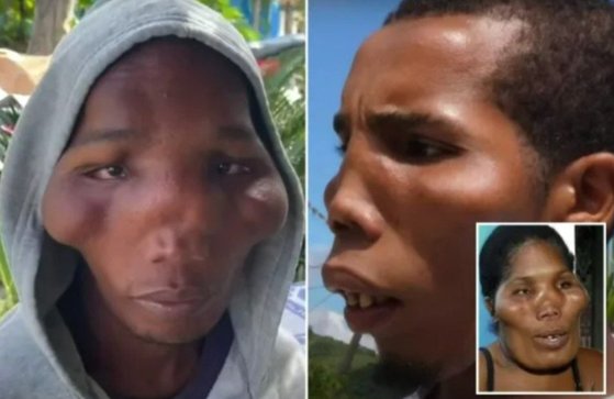 '사자 얼굴 증후군'에 걸린 도미니카공화국 남매.jpg | 인스티즈
