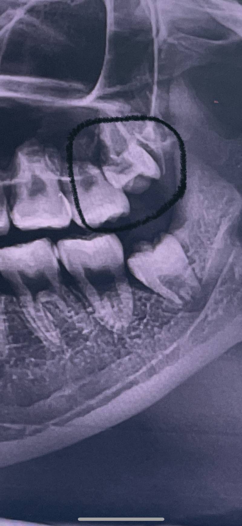 [잡담] 나 사랑니ㅠㅠㅠㅠㅠ | 인스티즈