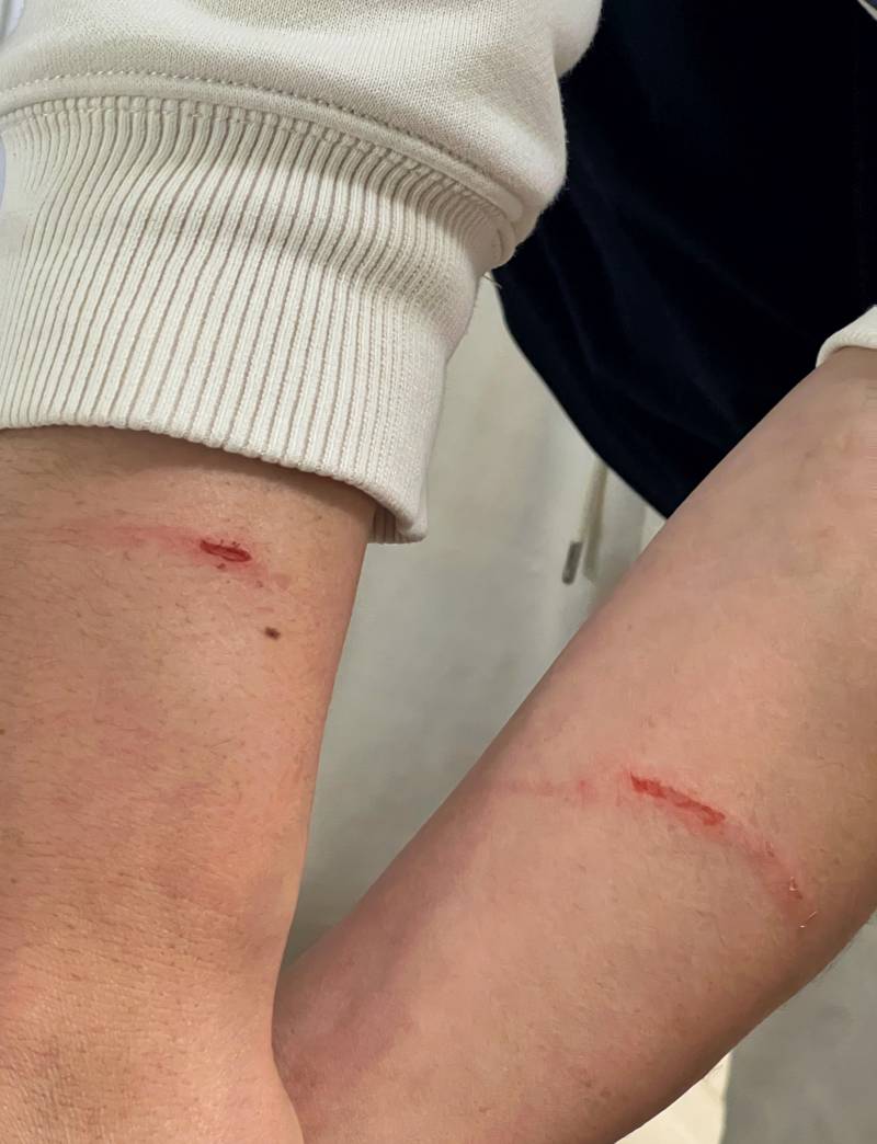 [잡담] 남편이 회식자리에서 맥주병으로 맞아서 응급실갔다왔어 | 인스티즈