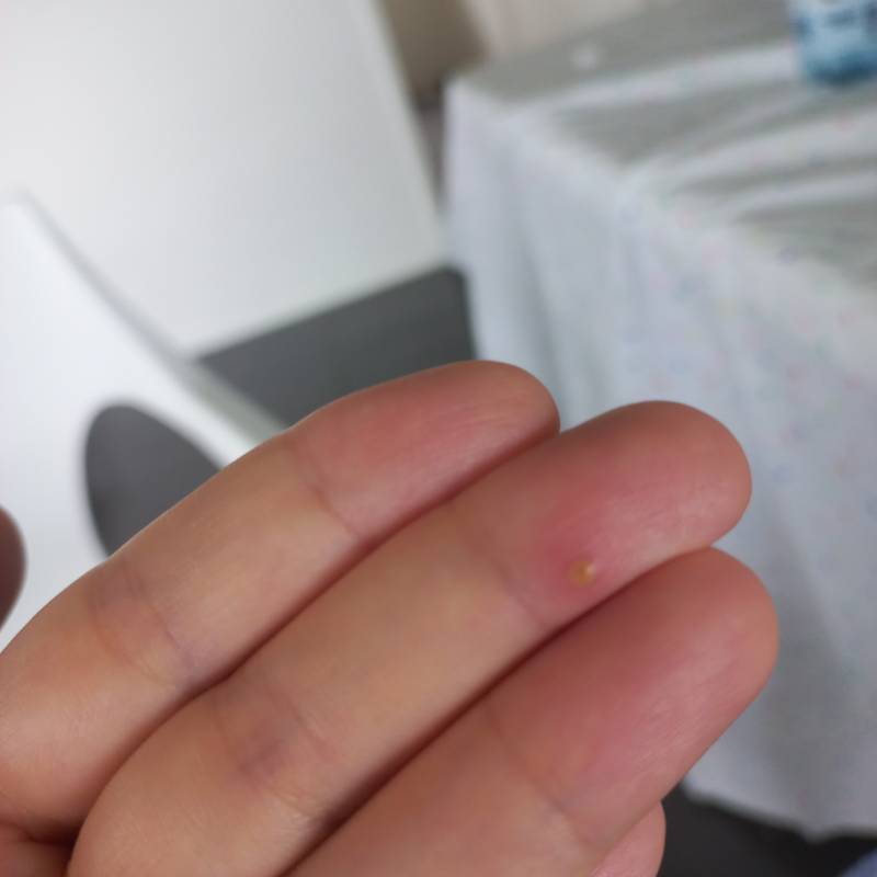 [잡담] 얘들아 손에 이거 뭘까 ㅜㅜ | 인스티즈