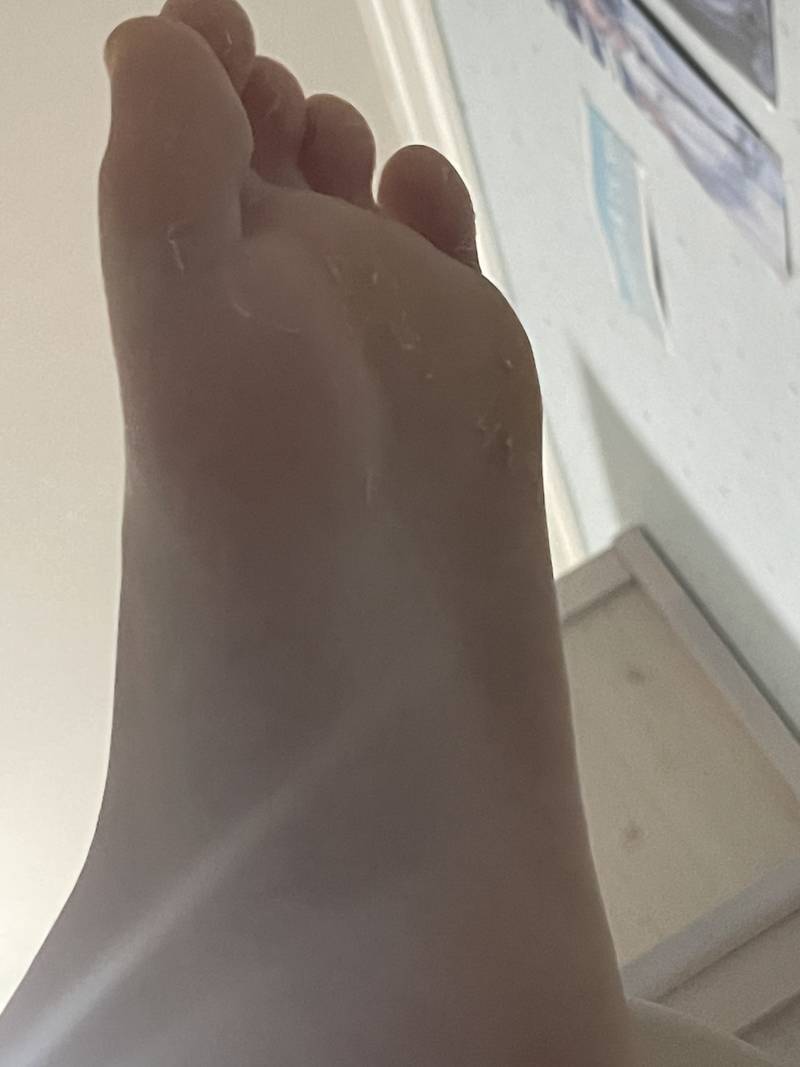 [잡담] 이거 무좀이야 ㅠㅠㅠ? | 인스티즈