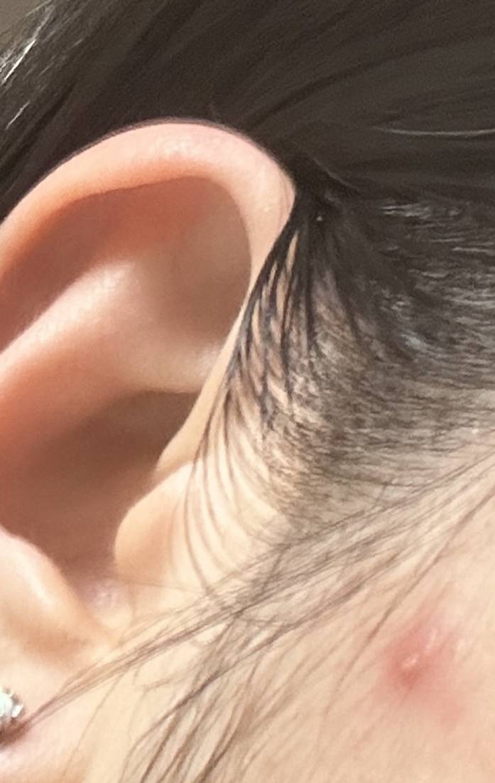 [잡담] 익드라 나 제발 도와줘 … 여드름 ㅠㅠ | 인스티즈