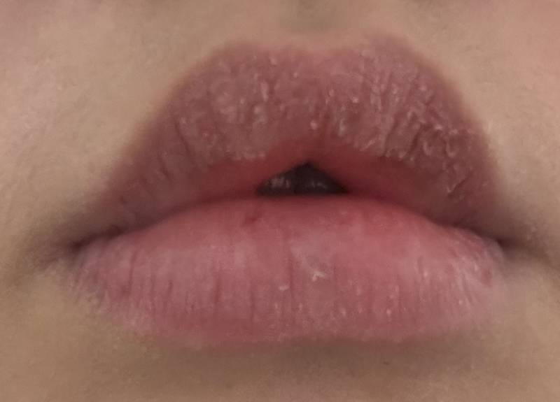 [잡담] 입술 각질 너무 많이 일어나는데 이거 병원 가야하나 ..? | 인스티즈