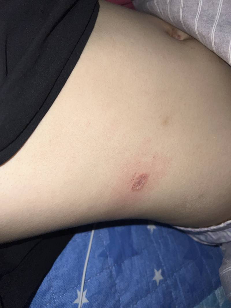 [잡담] 배에 뭐가 난거같은데 뭘까..? | 인스티즈