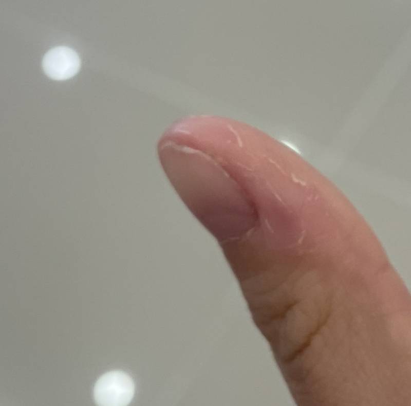 [잡담] 손톱 주변 이런 피부는 어떻게 관리해..? | 인스티즈