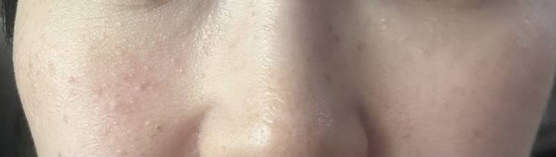 [잡담] 이런 피부... 피부과가면 해결방법 있을까? | 인스티즈