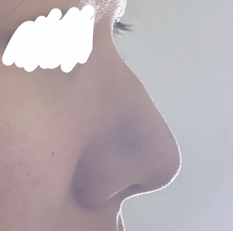 [잡담] 자연 높은 코 인데 ㅜ 수술할까.? | 인스티즈