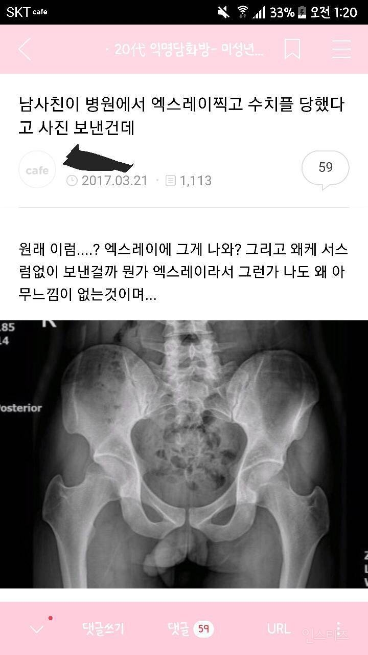 골반 엑스레이 찍고 수치플 당한 남사친.jpg | 인스티즈
