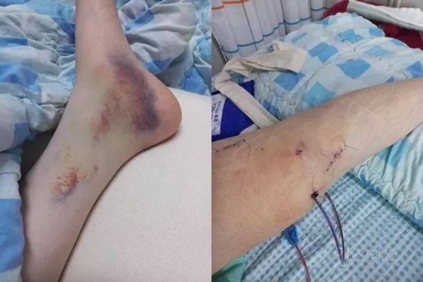 술 취한 미군, 20대 여성에 집적대다 넘어뜨리고 깔아뭉개... "무릎 인대 다 파열됐습니다" | 인스티즈
