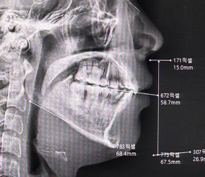 [잡담] 내 교정 전 후 볼 사람 | 인스티즈