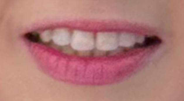[잡담] 나 입꼬리? 비대칭 심한데 이거 입술필러+입꼬리필러+입꼬리보톡스 맞으면 좀 나아질까?!ㅠㅠㅠ | 인스티즈