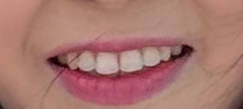 [잡담] 나 입꼬리? 비대칭 심한데 이거 입술필러+입꼬리필러+입꼬리보톡스 맞으면 좀 나아질까?!ㅠㅠㅠ | 인스티즈