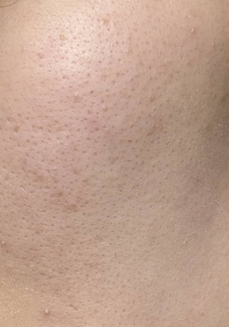 [잡담] ㅎㅇㅈㅇ 이 정도로 피부과 가는거 추천해??? | 인스티즈