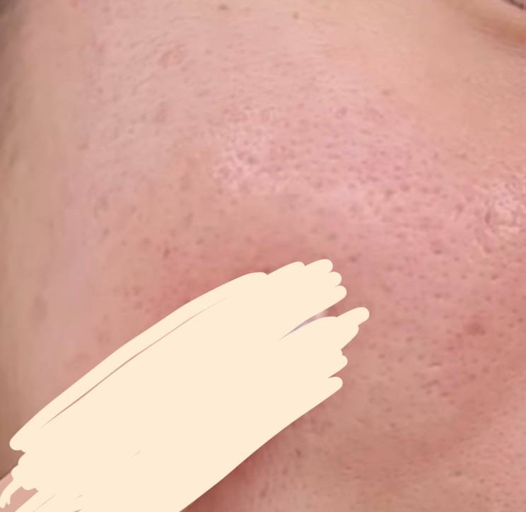 [잡담] 이런 피부는 답 없는 걸까 ㅠㅠ? | 인스티즈