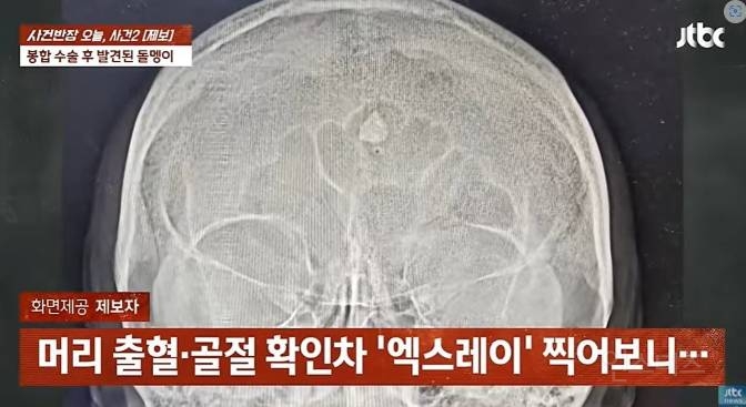 이마에 1㎝ 돌조각 박혔는데 그냥 꿰맨 의사 | 인스티즈