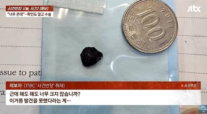 이마에 1㎝ 돌조각 박혔는데 그냥 꿰맨 의사 | 인스티즈