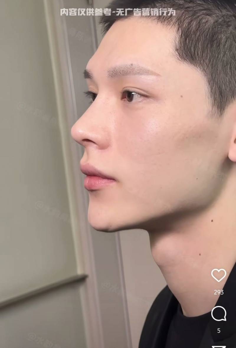 공개되고 충격적이라는 반응많았던 코 수술 사진..JPG | 인스티즈