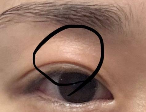 [잡담] 이거 아토피 때문에 계속 붓고 건조해지고 그러는건가? 따갑다ㅠㅠ 아무리 로션 발라도 그러네ㅠㅠ | 인스티즈