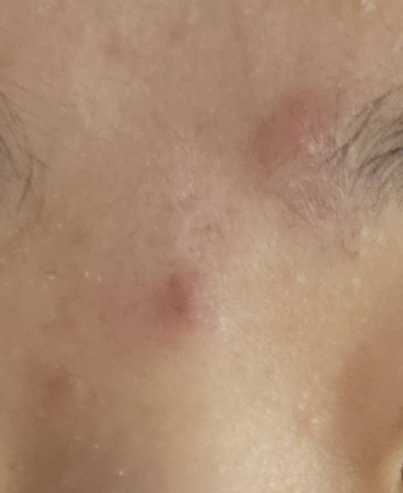 [잡담] 진짜 급한데 이런 여드름 어떻게 빨리 가라앉혀 ㅠㅠ???? | 인스티즈