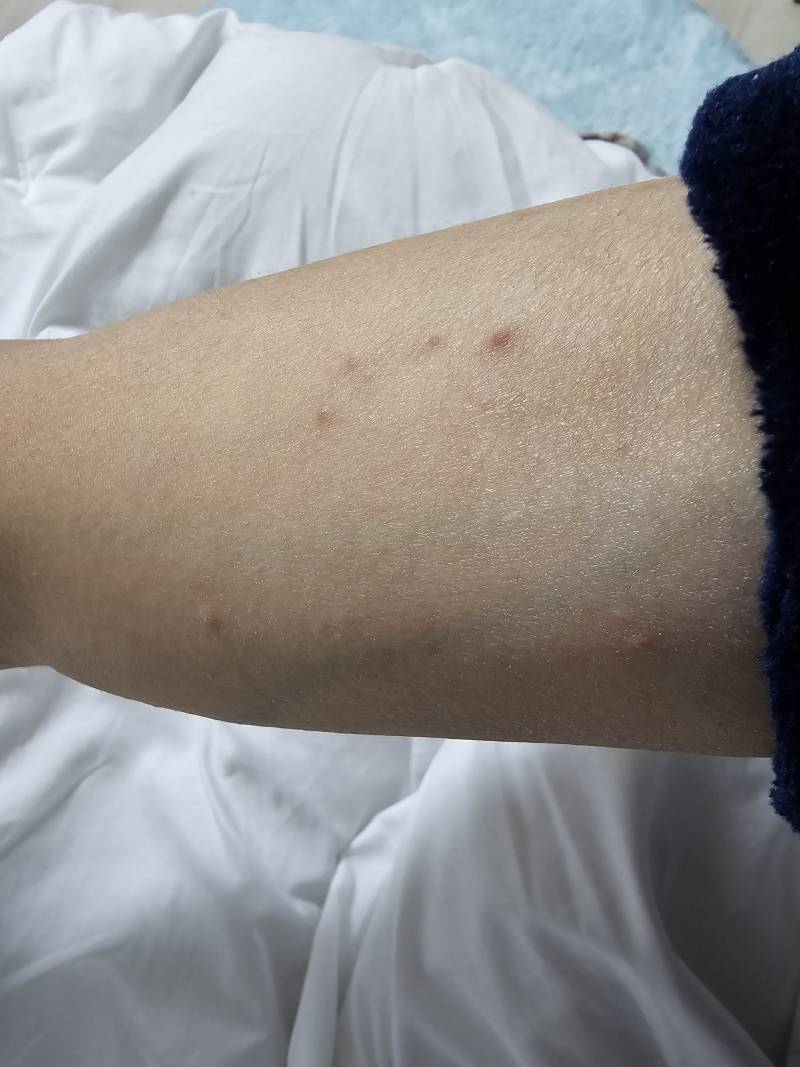 [잡담] 몸에 작은 수포같은거 군데군데 생겼는데 목욕해도 되나 | 인스티즈