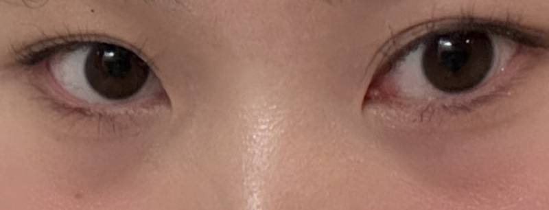 [잡담] 눈 밑 다크가 점점 진해지는데 지방 재배치를 받아야하는 눈일까? | 인스티즈