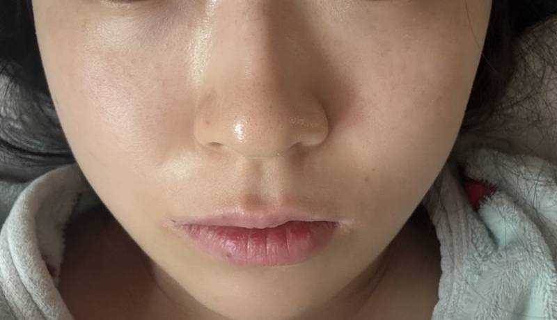 [잡담] 나 주근깨기미 많이 없어졌지??? 아근데 완전히 없애버리고 싶다ㅠㅠ | 인스티즈