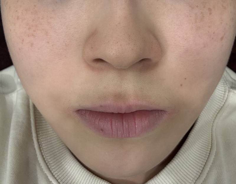 [잡담] 나 주근깨기미 많이 없어졌지??? 아근데 완전히 없애버리고 싶다ㅠㅠ | 인스티즈
