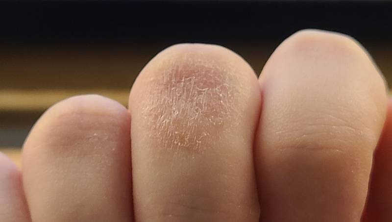 [잡담] 혐오주의) 내 손가락 왜 이러지?? | 인스티즈