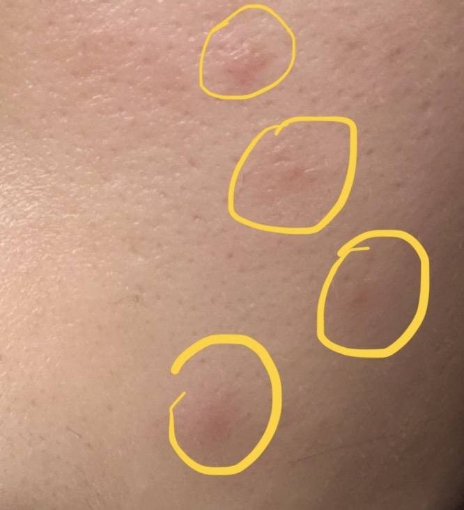 [잡담] 이거 지금 여드름 번지는걸까? | 인스티즈