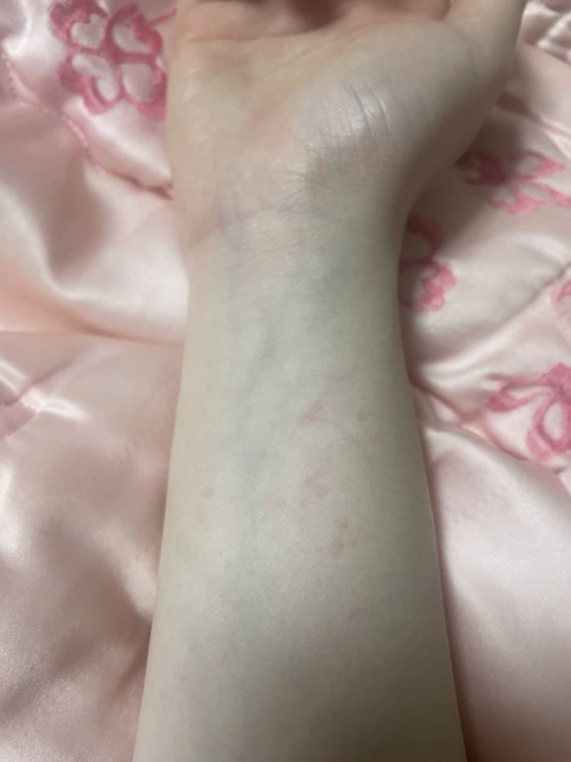 [잡담] 손목에 생긴거 이거 알러지야? ㅎㅇㅈㅇ | 인스티즈