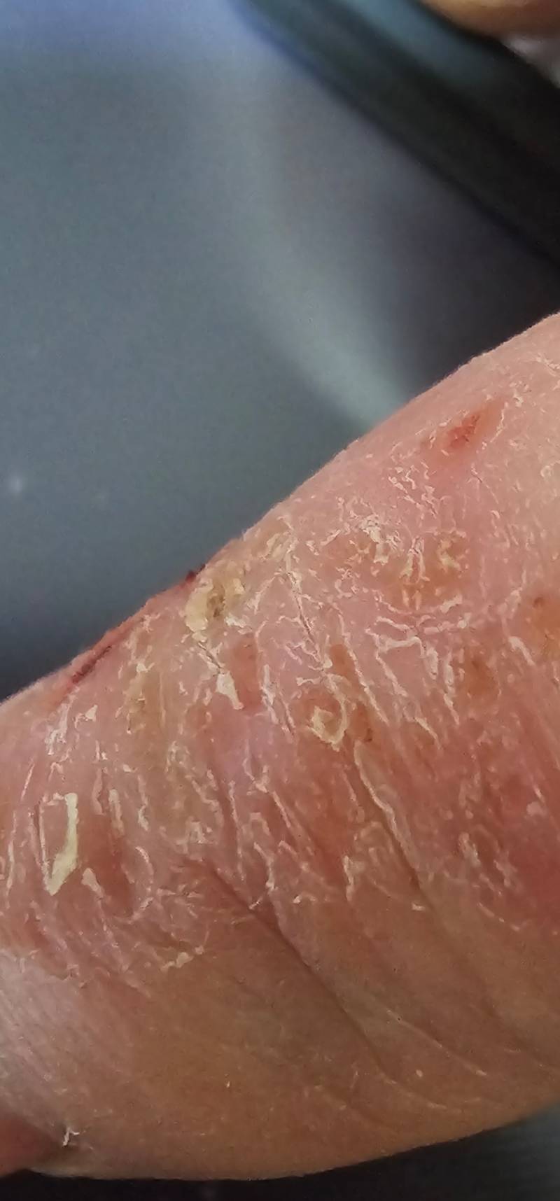 [잡담] 혐오주의 나 이거 한포진일까? 피부기포올라오고 나중에 미친듯이 가려워 | 인스티즈