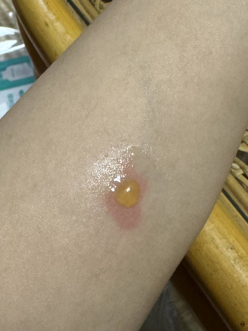 [잡담] 해외에서 화상 물집 생겨본 사람 있음?? 사진있음 | 인스티즈