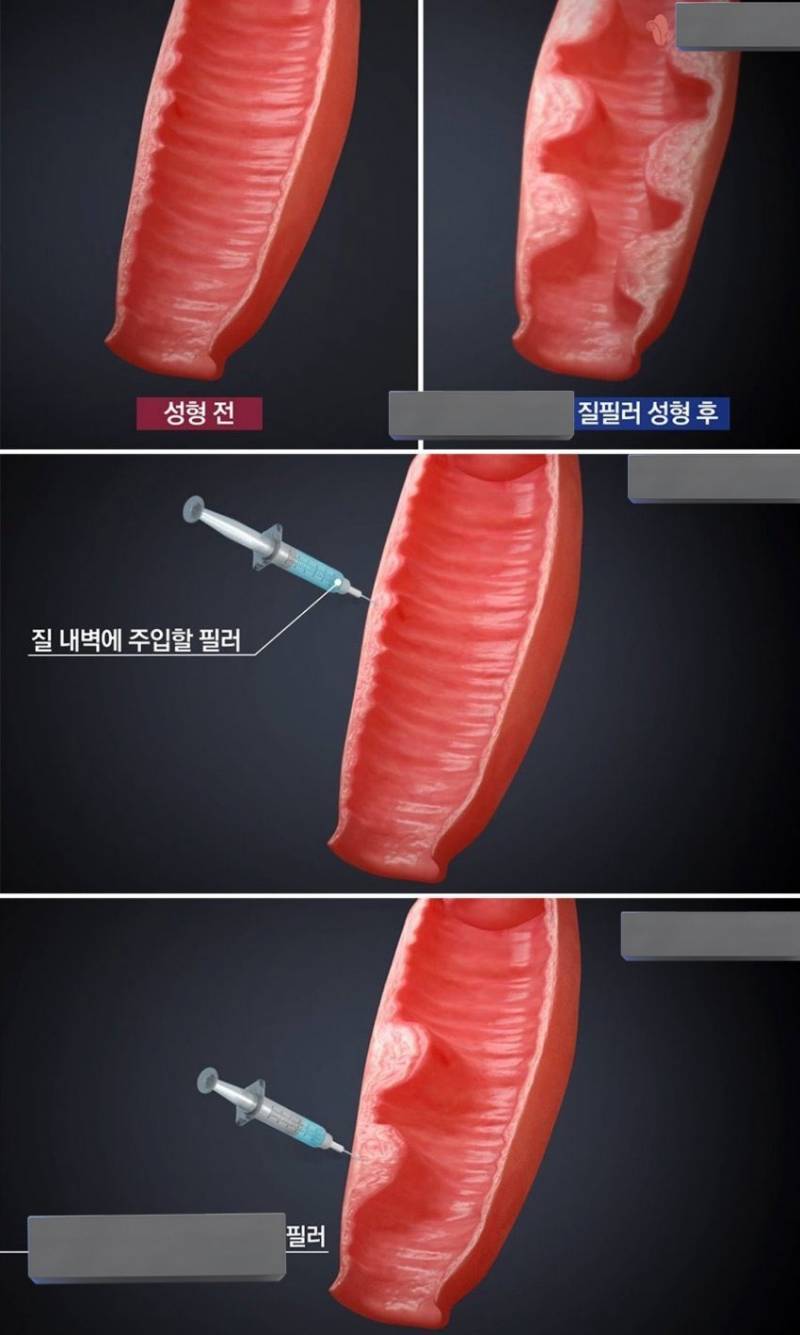 경악스럽다는 질 필러 시술 후기.JPG | 인스티즈