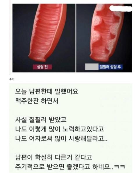  경악스럽다는 질 필러 시술 후기.JPG