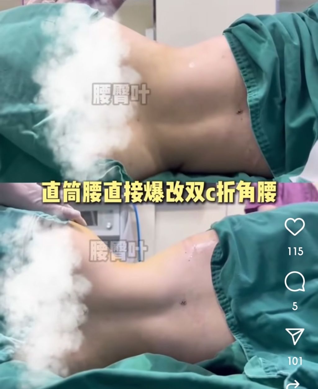 [정보/소식] 점점 기괴해지는 중국의 성형 근황 (허리) | 인스티즈