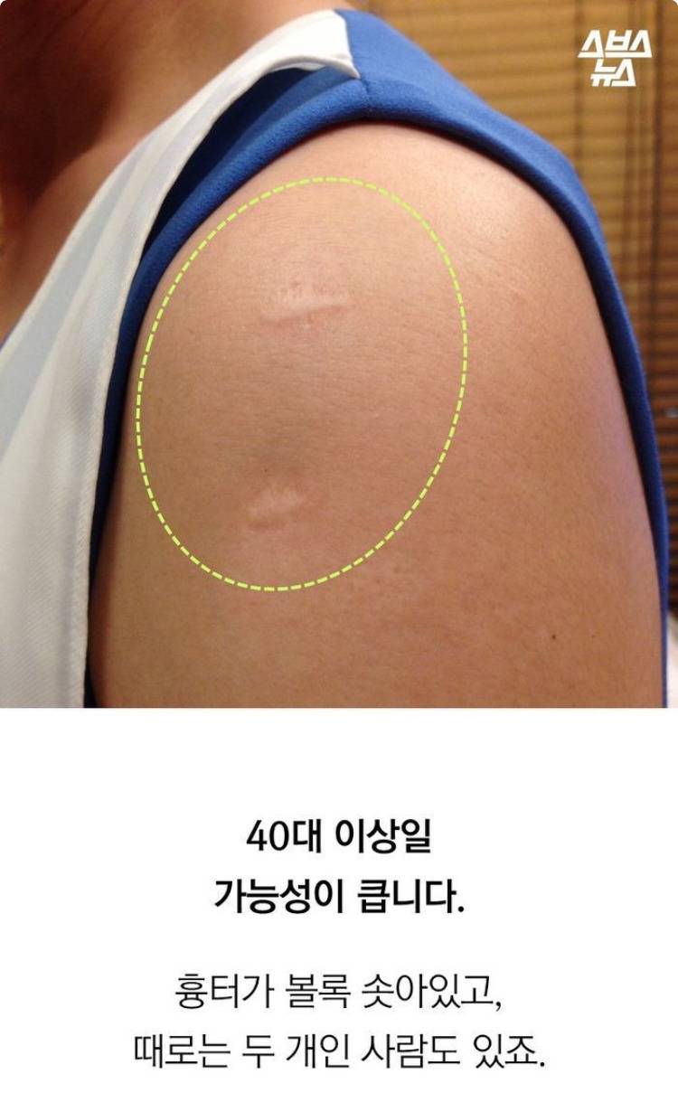  현재 답변 갈리는 불주사 자국.JPG