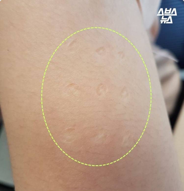 현재 답변 갈리는 불주사 자국.JPG | 인스티즈