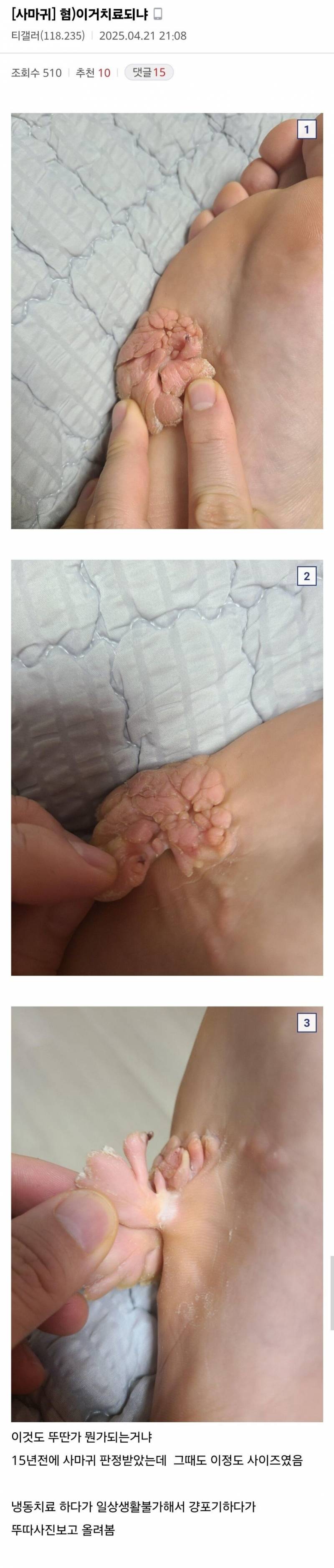 혐짤주의) 오늘자 티눈갤에 올라온 역대급 사마귀 | 인스티즈
