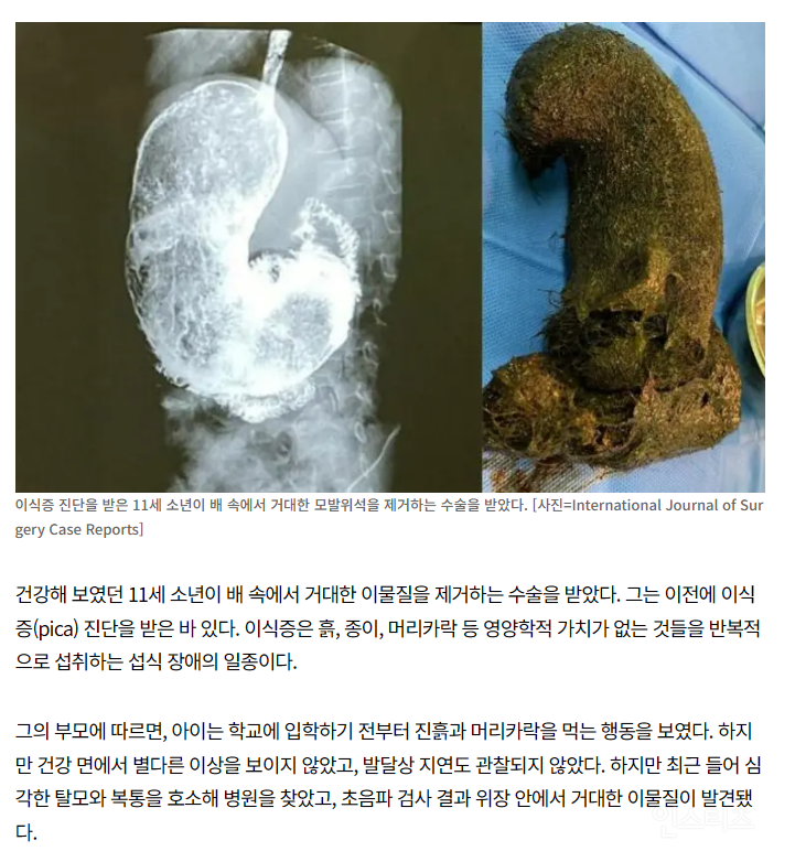 (사진주의)진흙 덩어리? 11세 배 속에 뭐야?...거대한 정체 봤더니, 소년이..