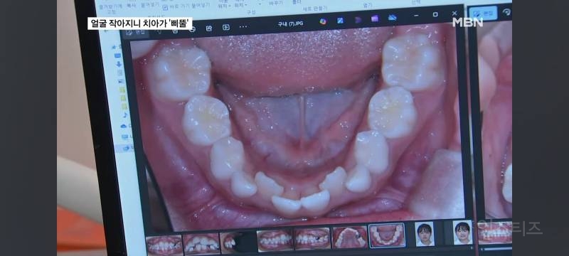 얼굴이 작아져서 치아가 기형으로 나고있다는 요즘 애들.jpg | 인스티즈