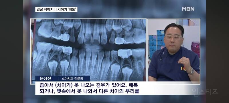 얼굴이 작아져서 치아가 기형으로 나고있다는 요즘 애들.jpg | 인스티즈
