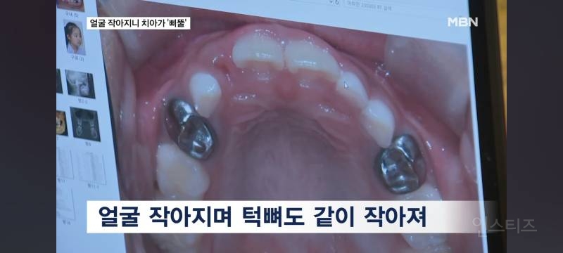 얼굴이 작아져서 치아가 기형으로 나고있다는 요즘 애들.jpg | 인스티즈