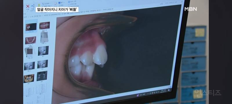 얼굴이 작아져서 치아가 기형으로 나고있다는 요즘 애들.jpg | 인스티즈