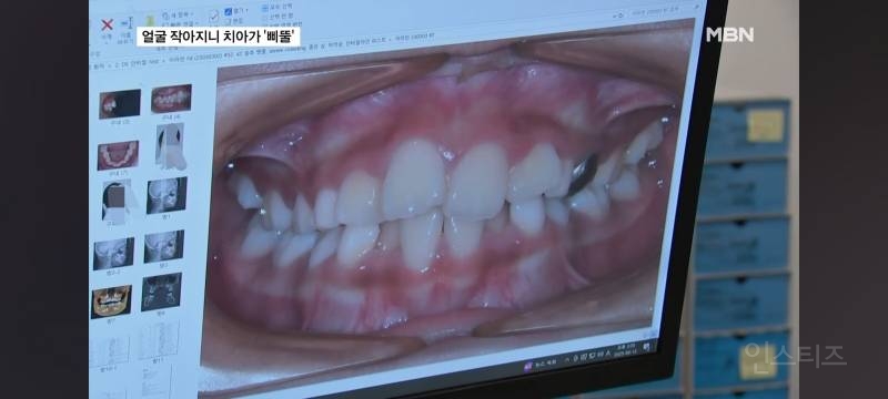  얼굴이 작아져서 치아가 기형으로 나고있다는 요즘 애들.jpg43