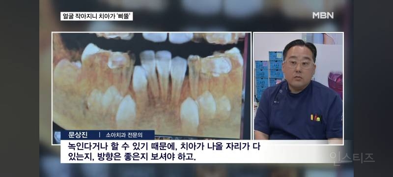 얼굴이 작아져서 치아가 기형으로 나고있다는 요즘 애들.jpg | 인스티즈