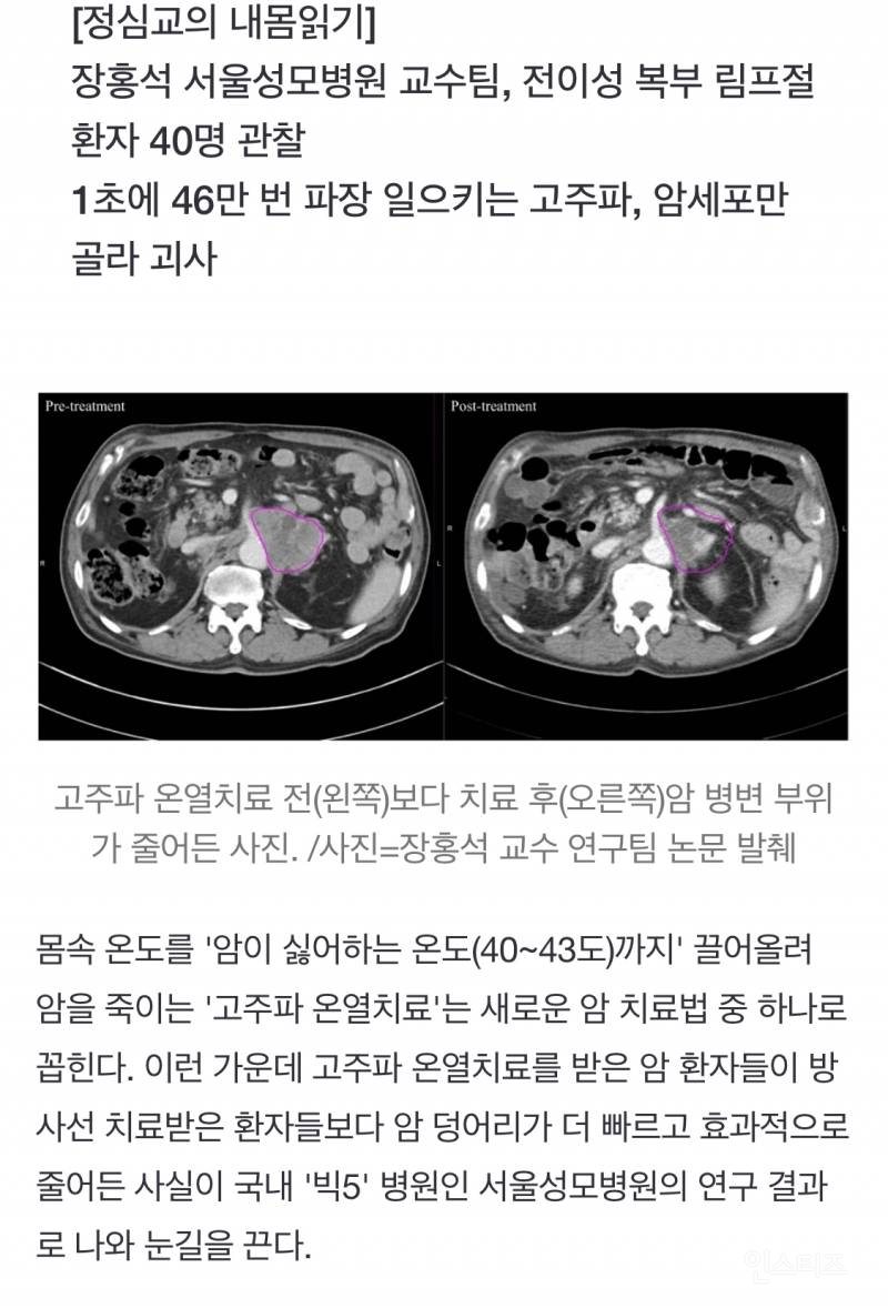 "암이 못 견디는 40~43도로 체온 올려 사멸" 온열치료 효과 국내서 입증 | 인스티즈