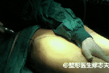 현재 개끔찍하다는 지방흡입 실제 시술 장면 (주의) | 인스티즈