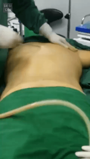 현재 개끔찍하다는 지방흡입 실제 시술 장면 (주의) | 인스티즈