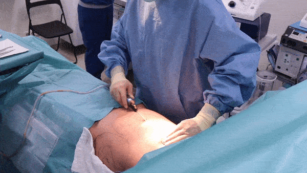 현재 개끔찍하다는 지방흡입 실제 시술 장면 (주의) | 인스티즈